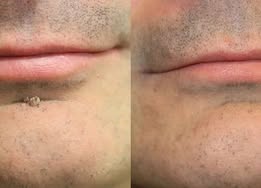 DermaFix – Målinriktad aknebehandlingsplåster