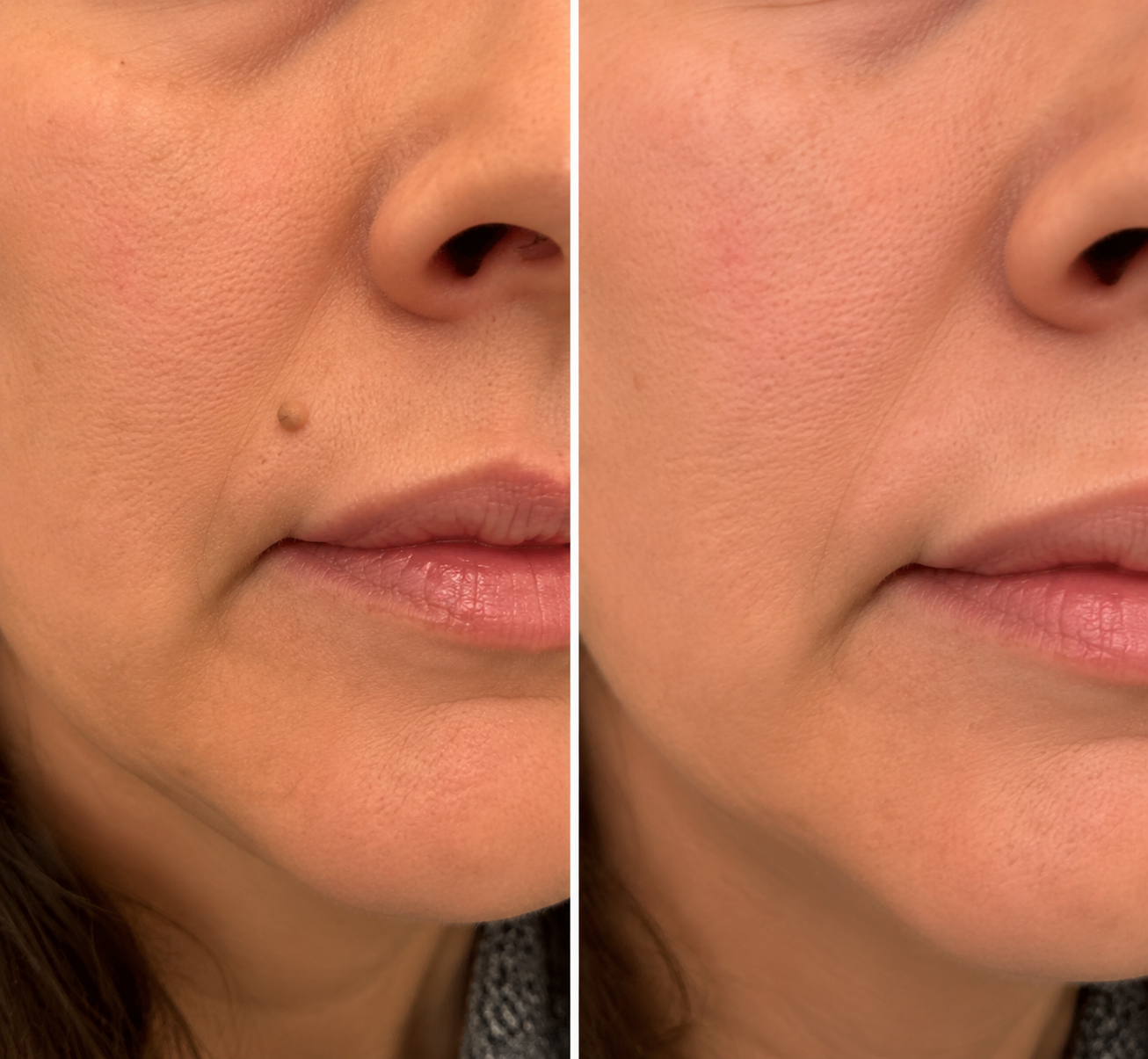 DermaFix – Målinriktad aknebehandlingsplåster