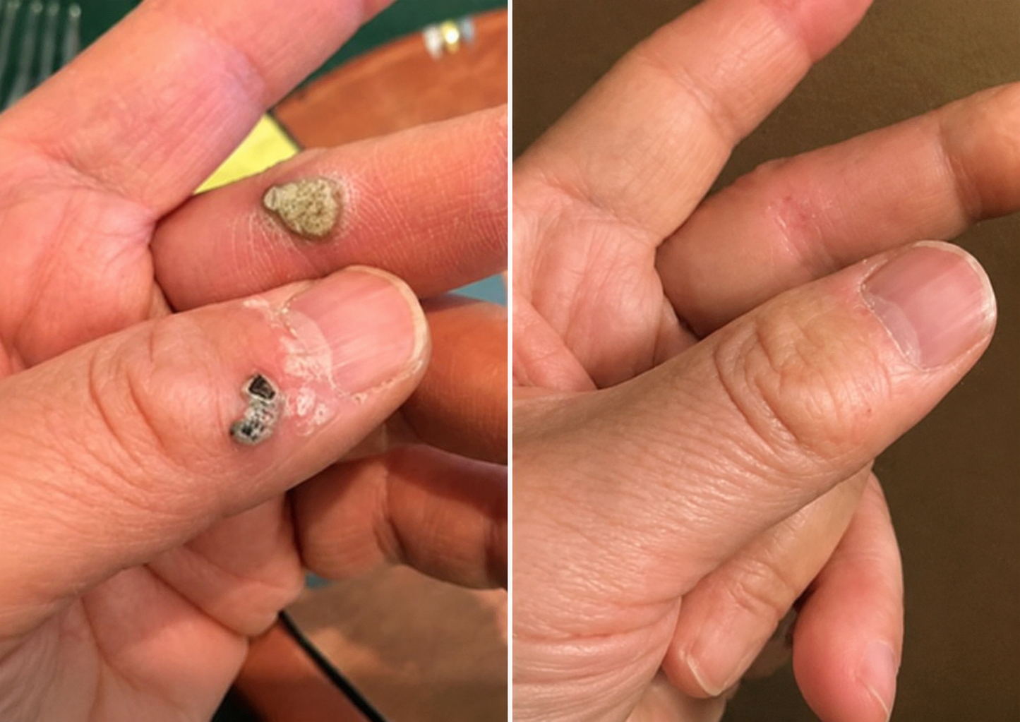 DermaFix – Målinriktad aknebehandlingsplåster